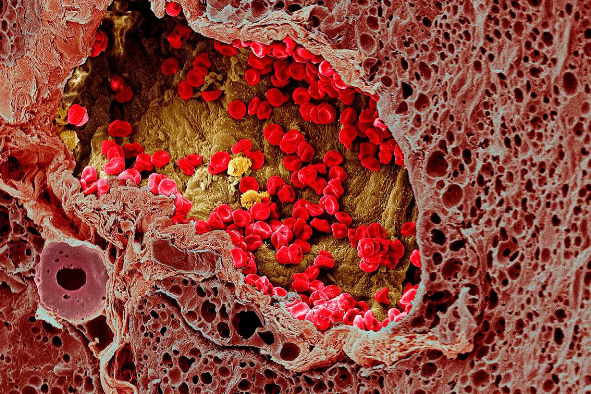 El melanoma es la causa más frecuente de mortalidad por cáncer de piel. Foto: Wellcome Collection
